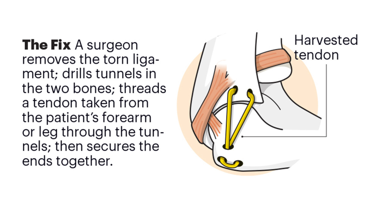 tommy john surgery